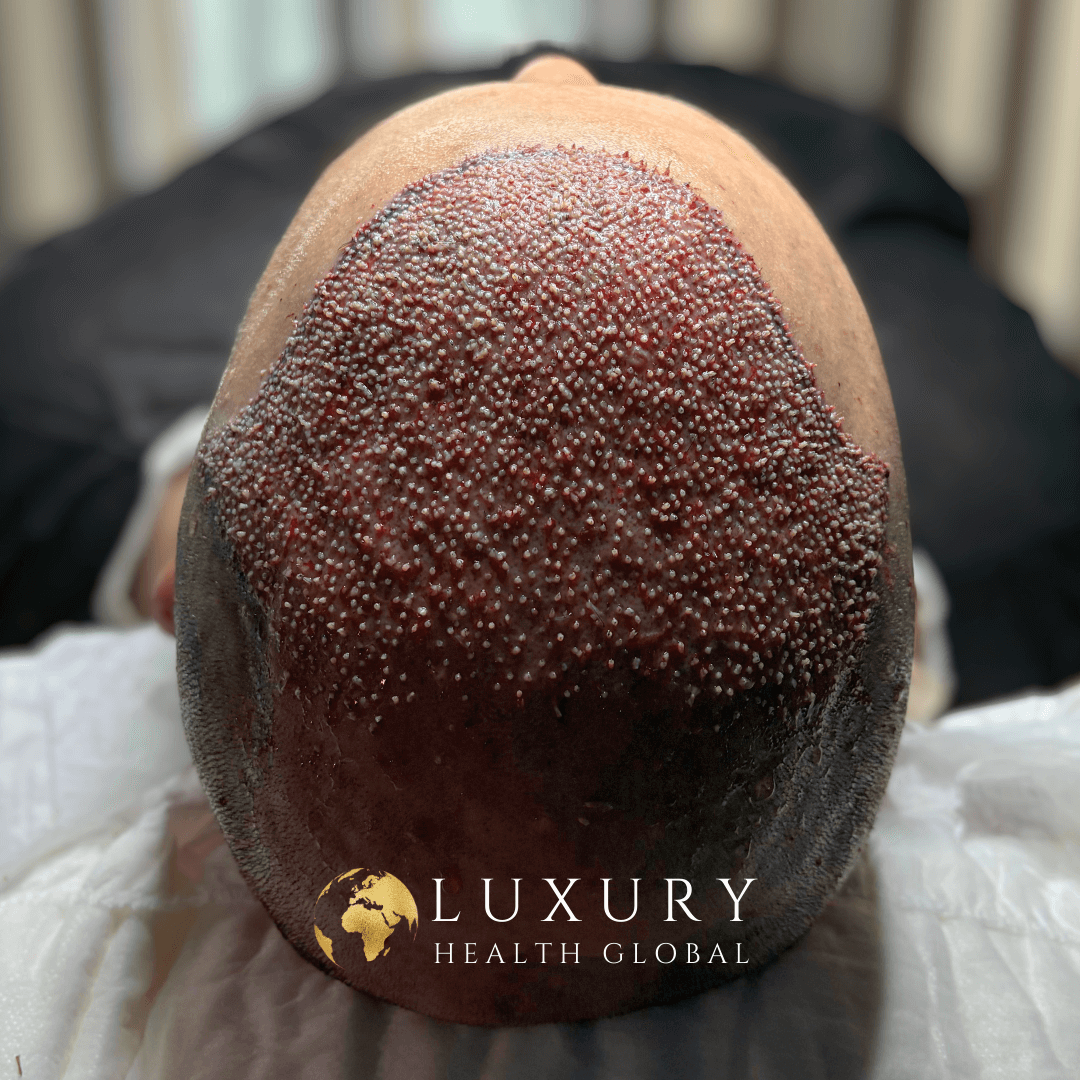 FUE Hair Transplant - 4000 Greft Öncesi