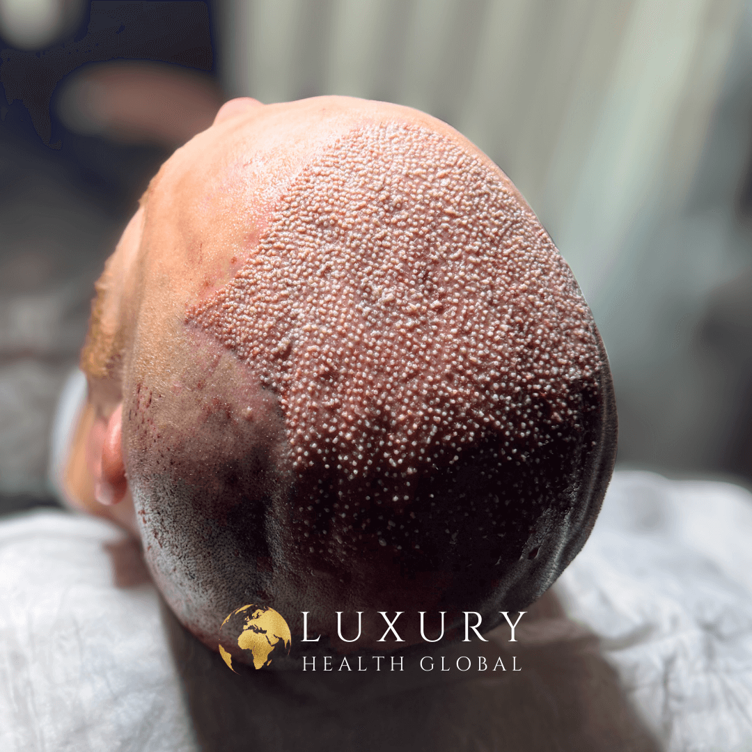 FUE Hair Transplant - 4500 Greft Öncesi