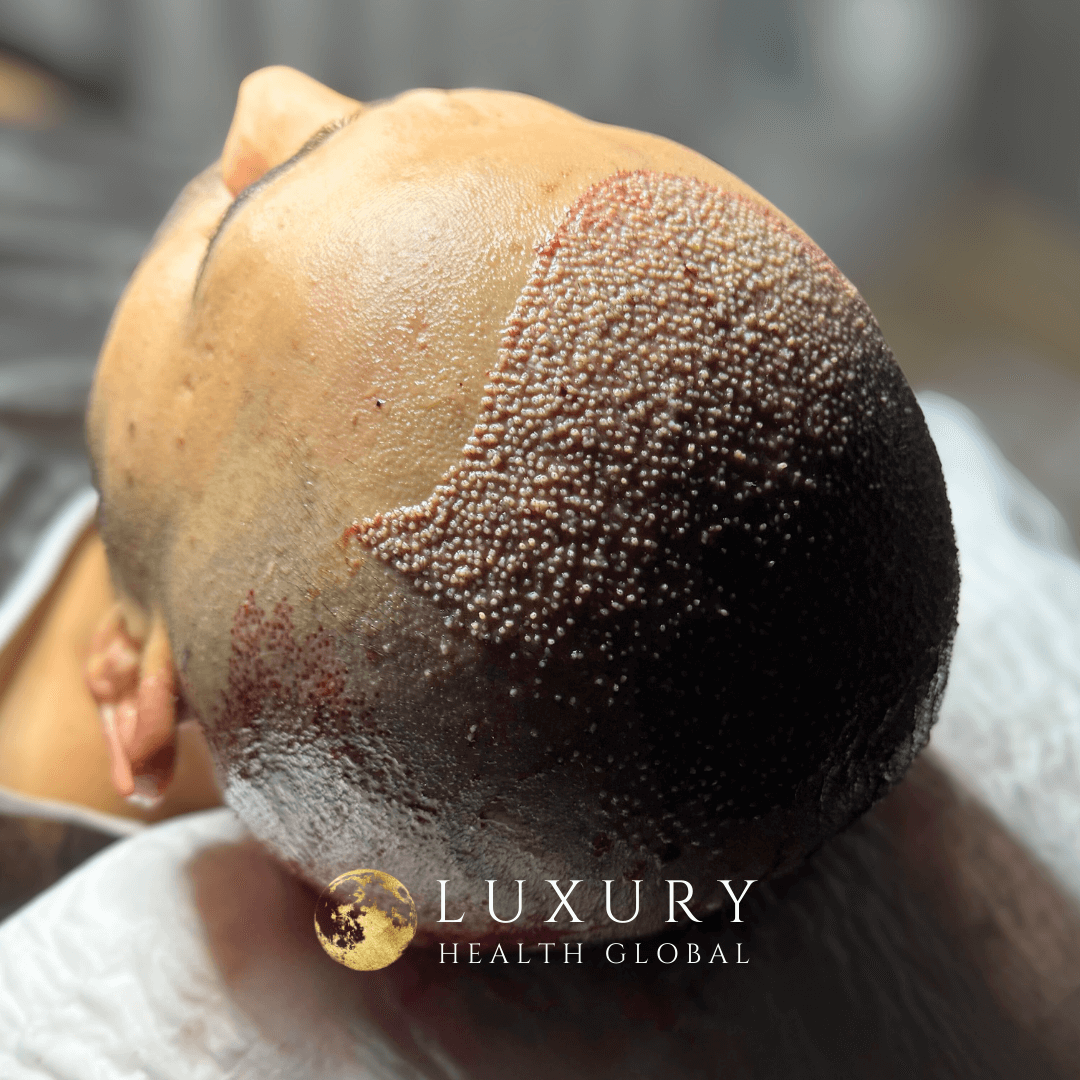 FUE Hair Transplant - 4700 Greft Öncesi