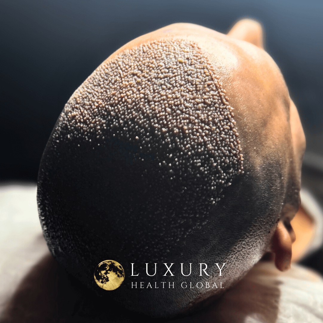 FUE Hair Transplant - 5100 Greft Öncesi
