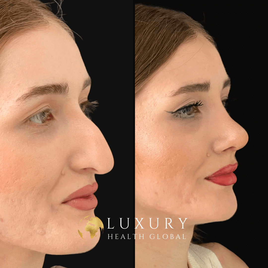 Burun Estetiği - 8 Month Result Öncesi