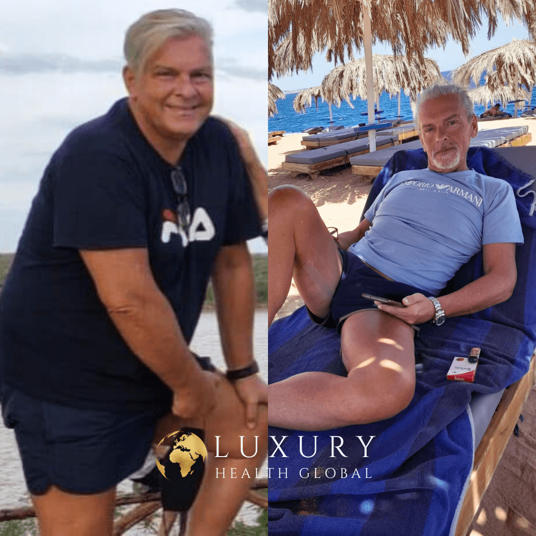 Obesity Surgery - 8 Month Result, 40 kg Kayıp Öncesi