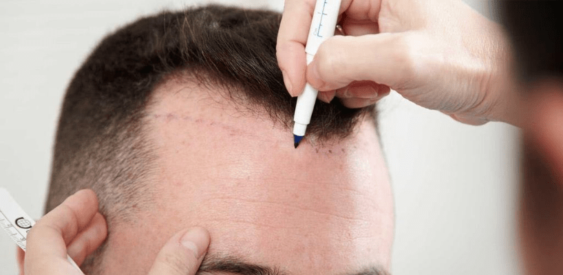 Hair Transplantation