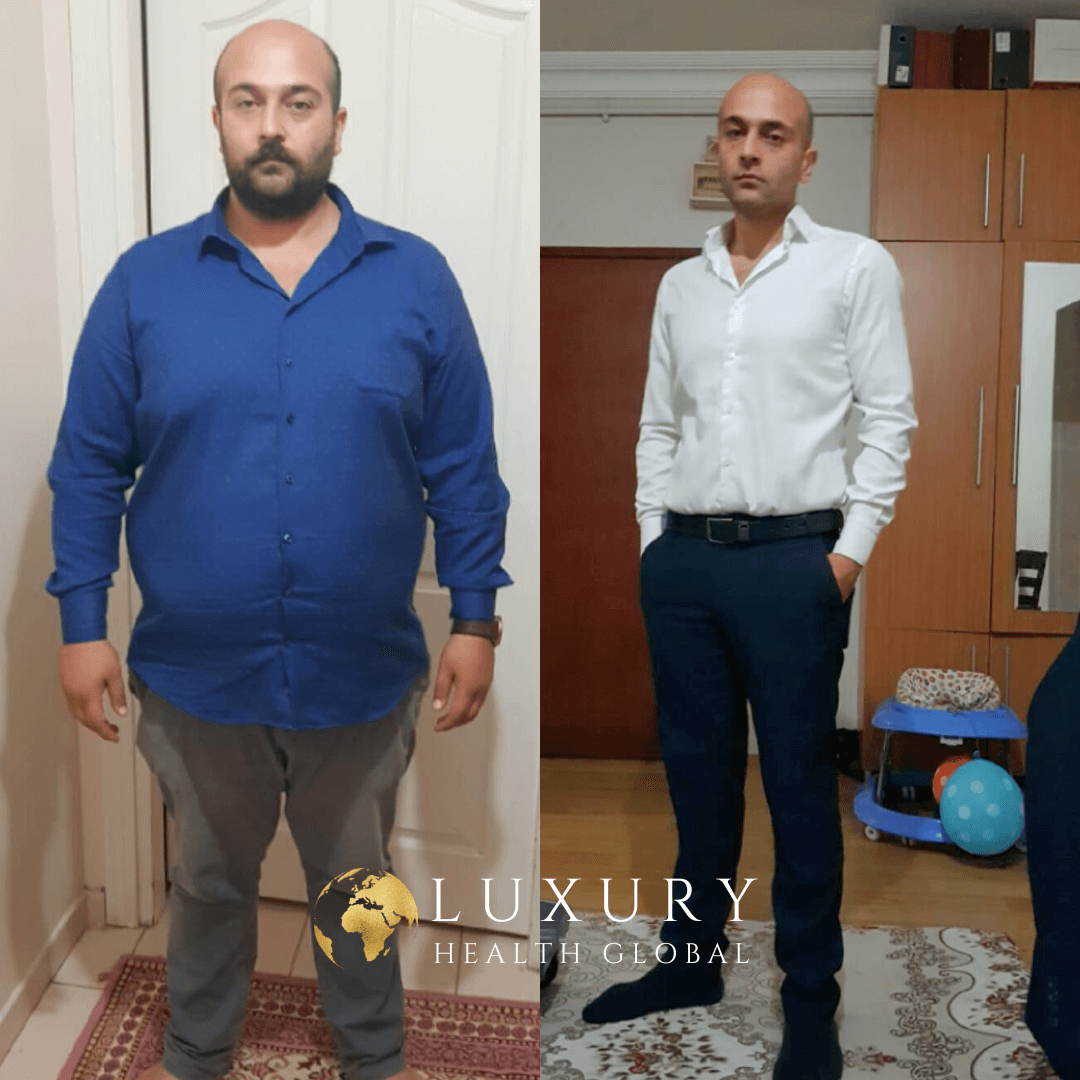 Obezite Cerrahisi - 1 Yıllık Sonuç, 60.4 kg Kayıp Öncesi
