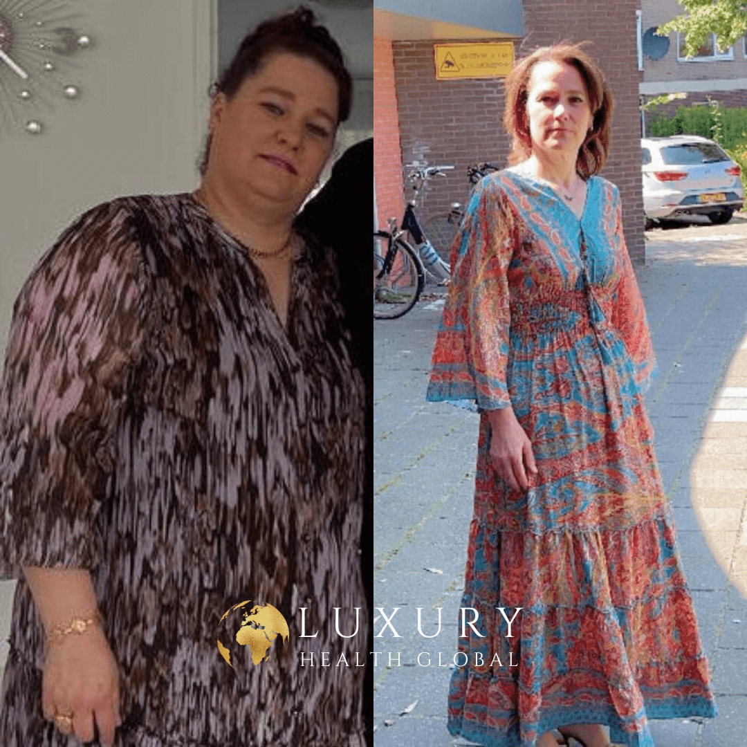 Obezite Cerrahisi - 7 Ayda 50 kg Kayıp Öncesi