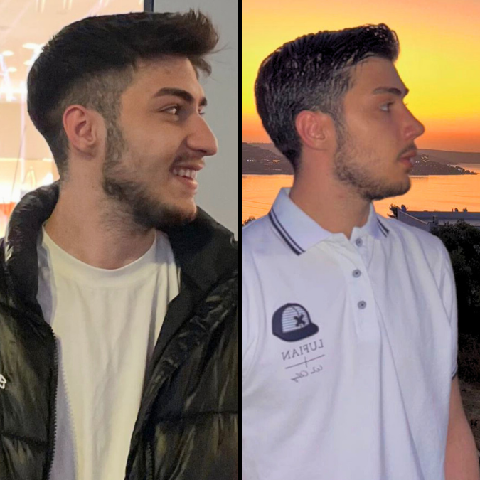 Burun Estetiği - 8 Aylık Sonuç Öncesi